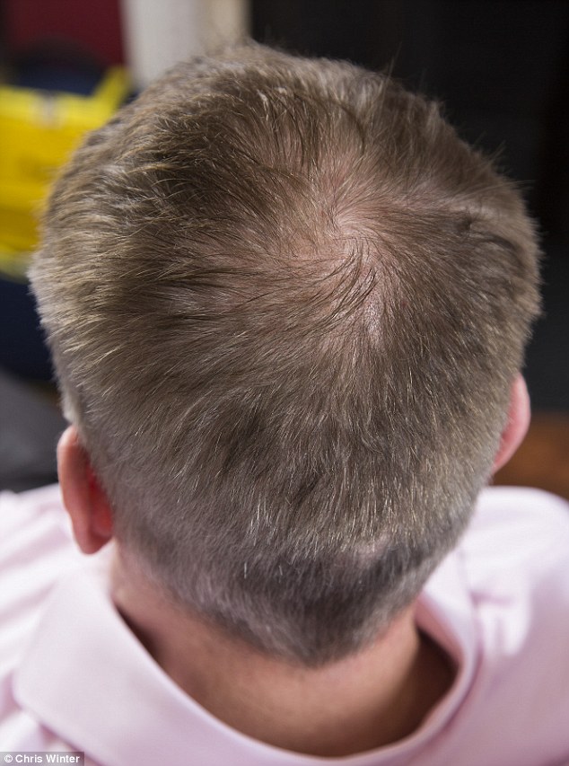 how to regrow new hair on scalp